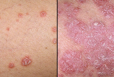 Psorasis